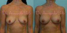 Before & After Breast Augmentation Case 23484 View #1 View in Orlando, FL
