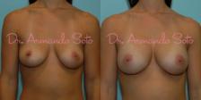 Before & After Breast Augmentation Case 23487 View #1 View in Orlando, FL