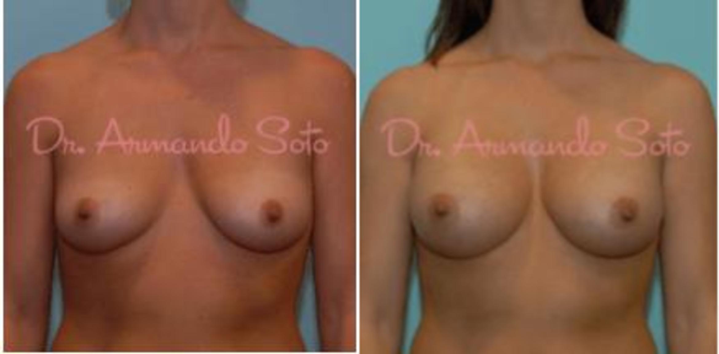Before & After Breast Augmentation Case 23488 View #1 View in Orlando, FL