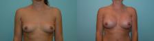 Before & After Breast Augmentation Case 23535 View #1 View in Orlando, FL