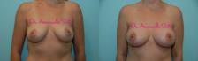Before & After Breast Augmentation Case 23537 View #1 View in Orlando, FL