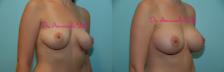 Before & After Breast Augmentation Case 23537 View #2 View in Orlando, FL