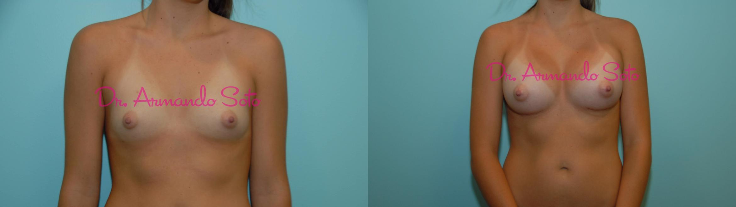 Before & After Breast Augmentation Case 23538 View #1 View in Orlando, FL