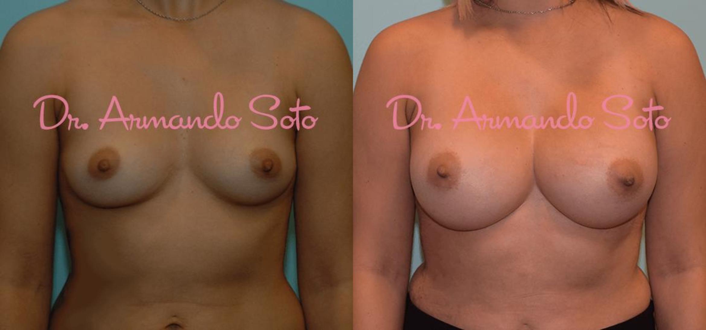 Before & After Breast Augmentation Case 23722 View #1 View in Orlando, FL