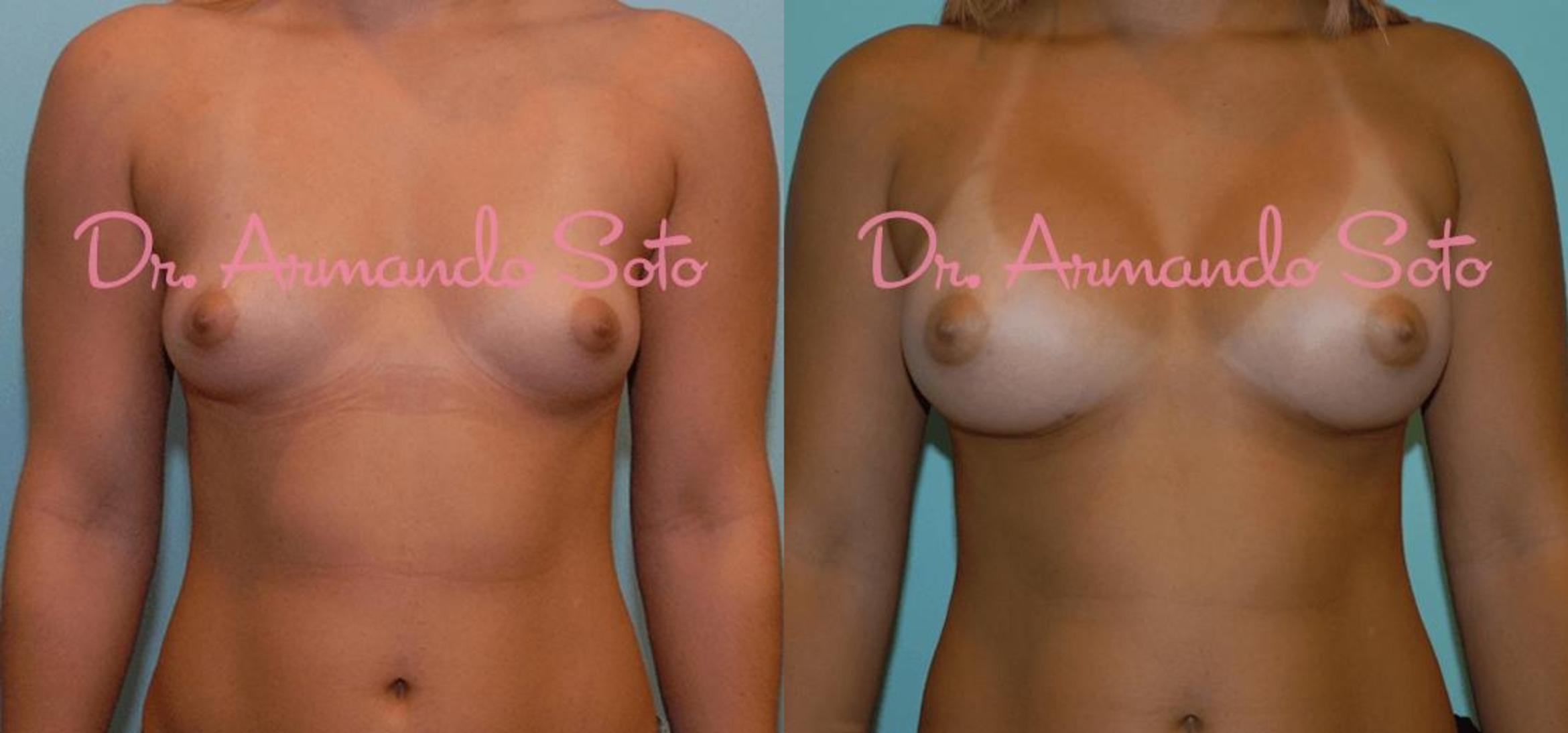 Before & After Breast Augmentation Case 23761 View #1 View in Orlando, FL