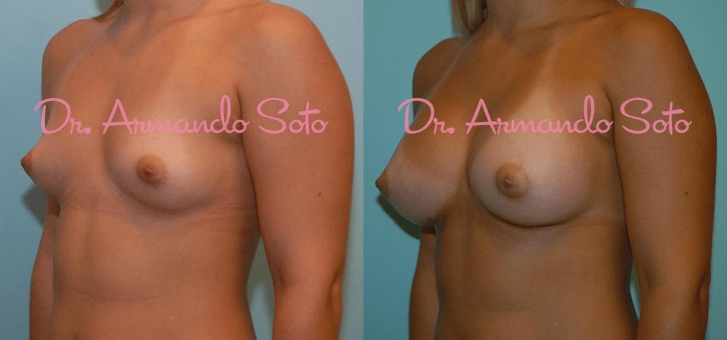 Before & After Breast Augmentation Case 23761 View #2 View in Orlando, FL