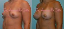 Before & After Breast Augmentation Case 23761 View #2 View in Orlando, FL