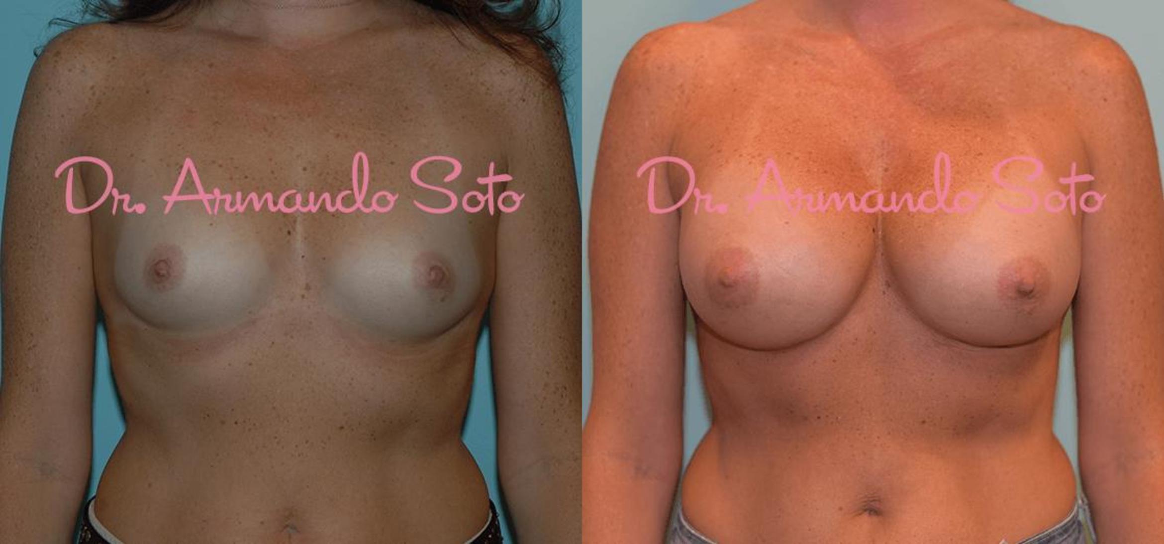 Before & After Breast Augmentation Case 23823 View #1 View in Orlando, FL