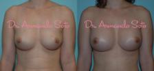Before & After Breast Augmentation Case 23824 View #1 View in Orlando, FL