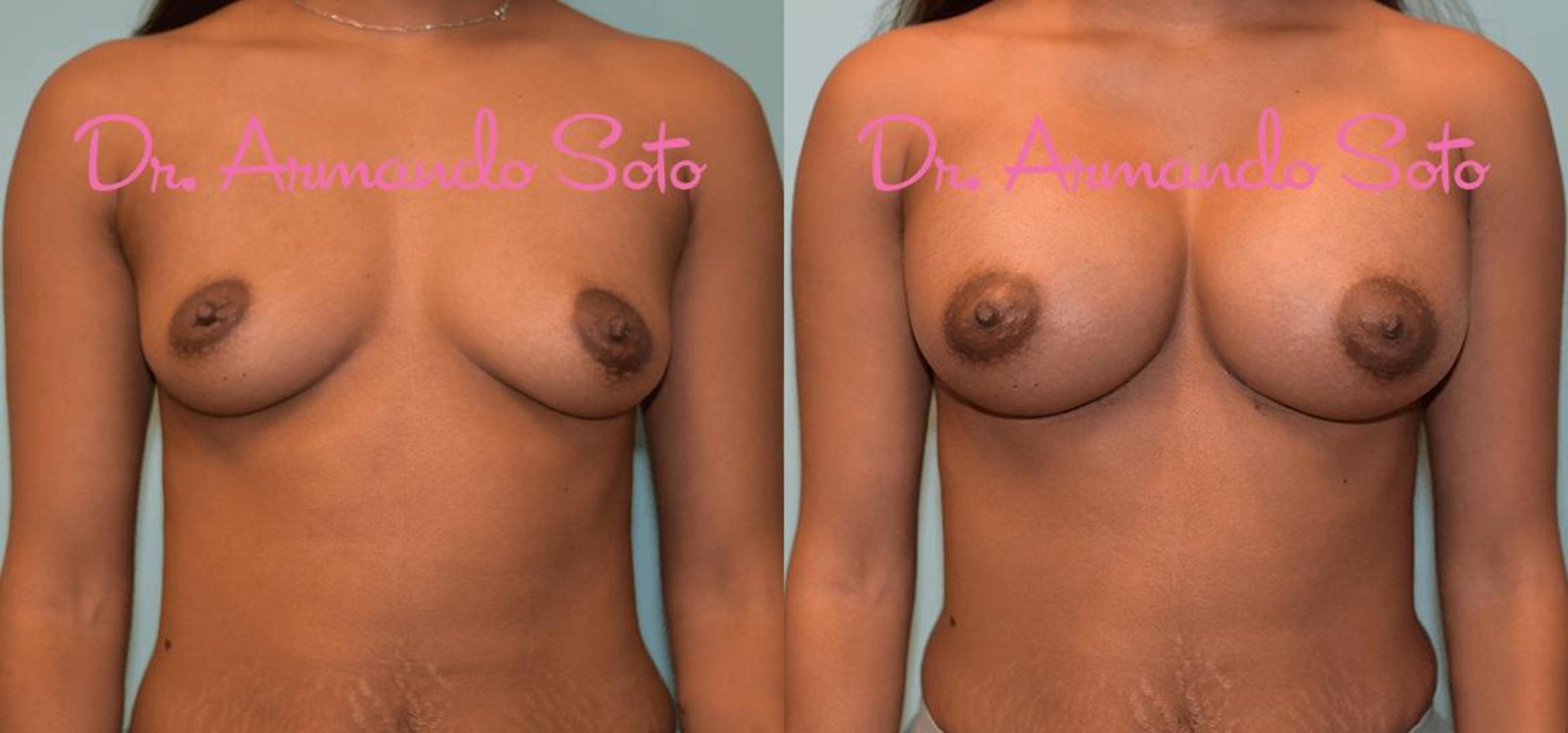 Before & After Breast Augmentation Case 24716 View #1 View in Orlando, FL