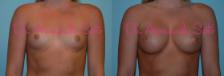 Before & After Breast Augmentation Case 27045 View #1 View in Orlando, FL