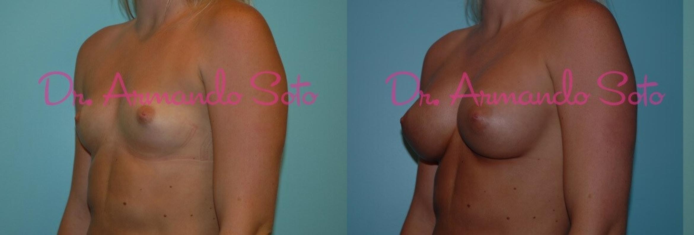 Before & After Breast Augmentation Case 27045 View #2 View in Orlando, FL