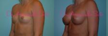 Before & After Breast Augmentation Case 27045 View #2 View in Orlando, FL