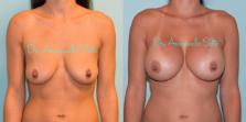 Before & After Breast Augmentation Case 27081 View #1 View in Orlando, FL