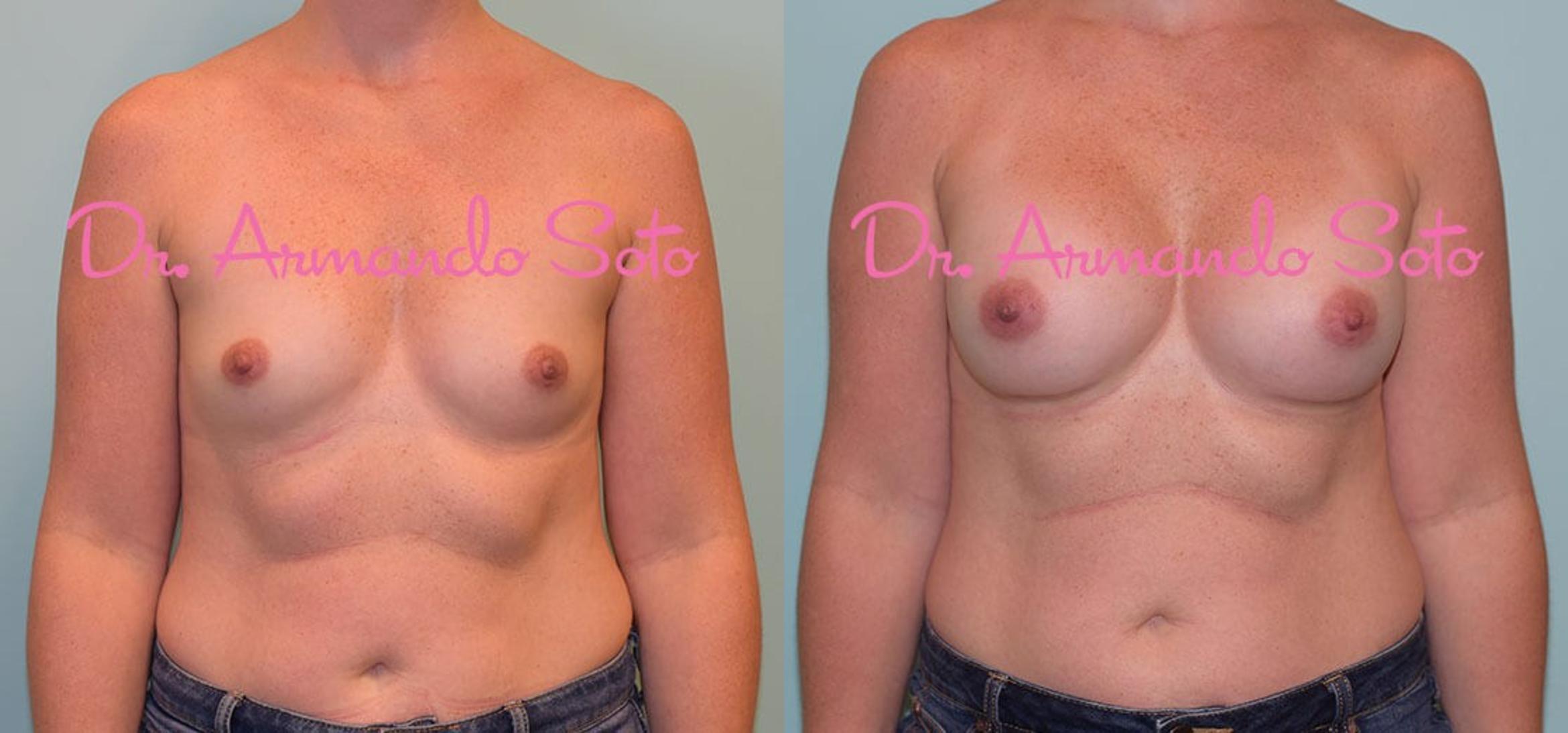 Before & After Breast Augmentation Case 28543 View #1 View in Orlando, FL