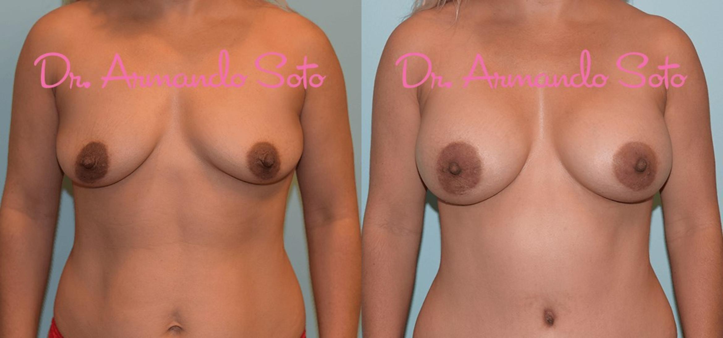 Before & After Breast Augmentation Case 28544 View #1 View in Orlando, FL