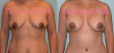 Before & After Breast Augmentation Case 28544 View #1 View in Orlando, FL