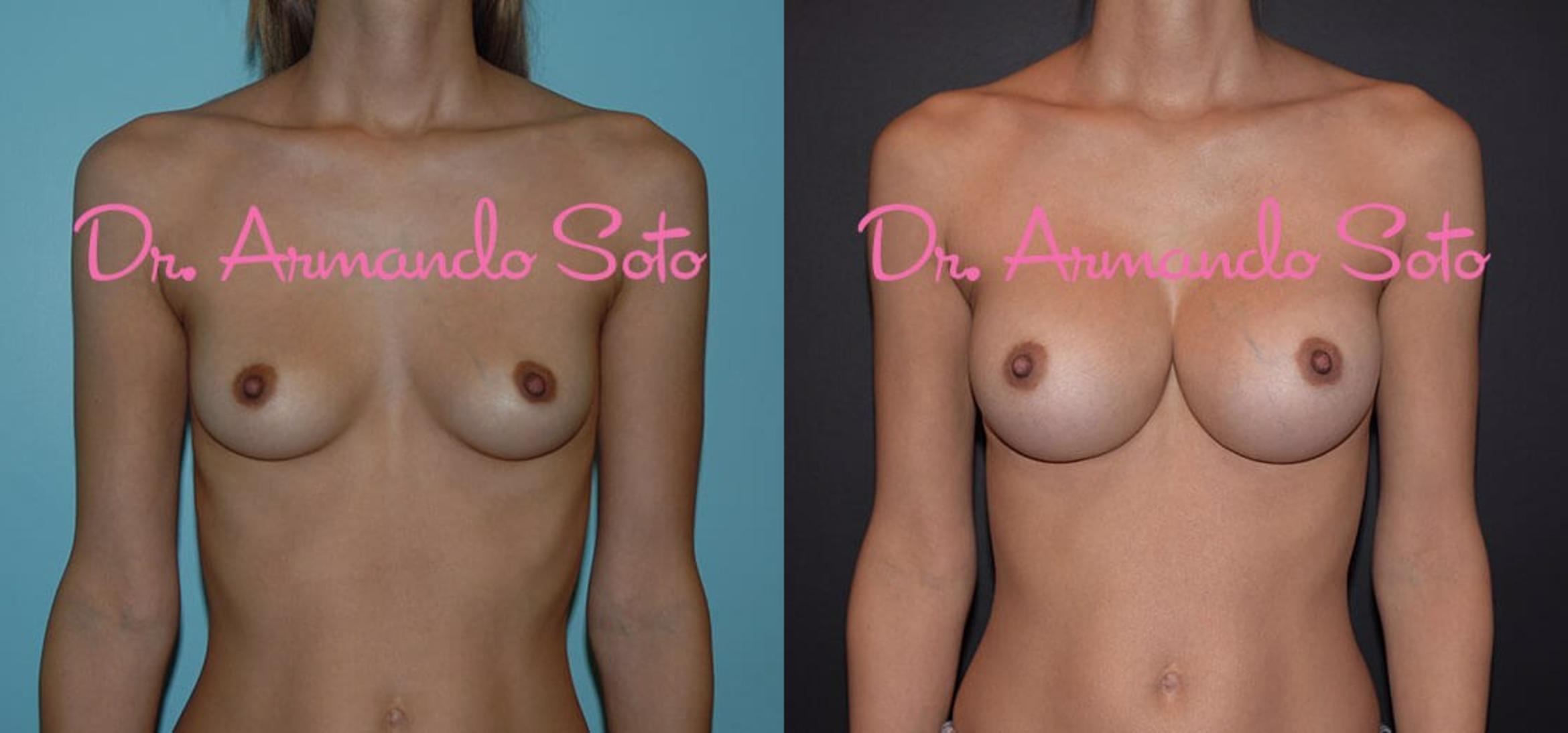 Before & After Breast Augmentation Case 29348 View #1 View in Orlando, FL