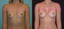 Before & After Breast Augmentation Case 29349 View #1 View in Orlando, FL