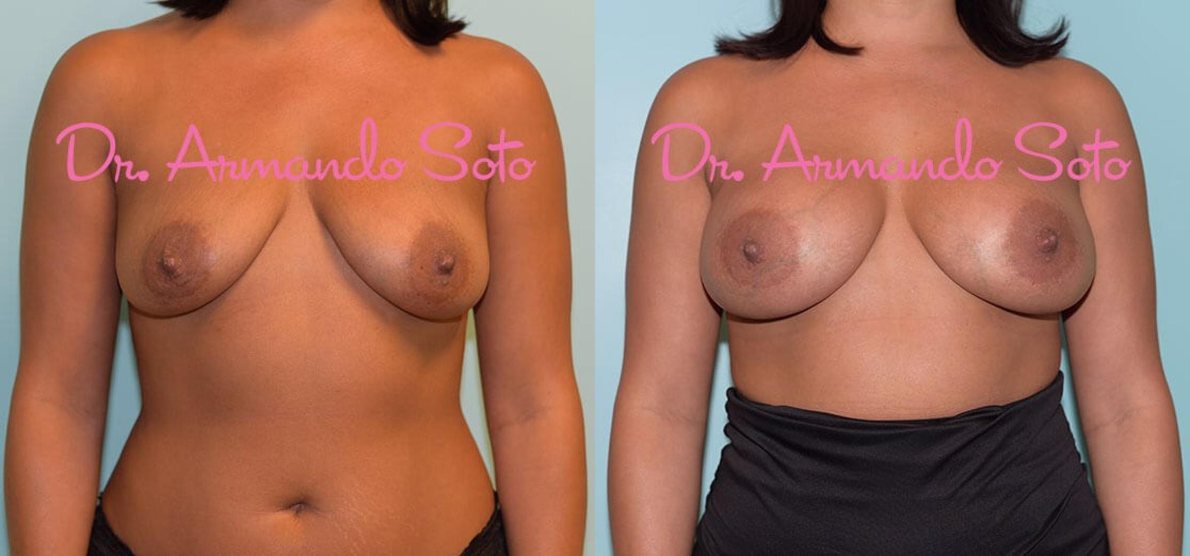 Before & After Breast Augmentation Case 29350 View #1 View in Orlando, FL