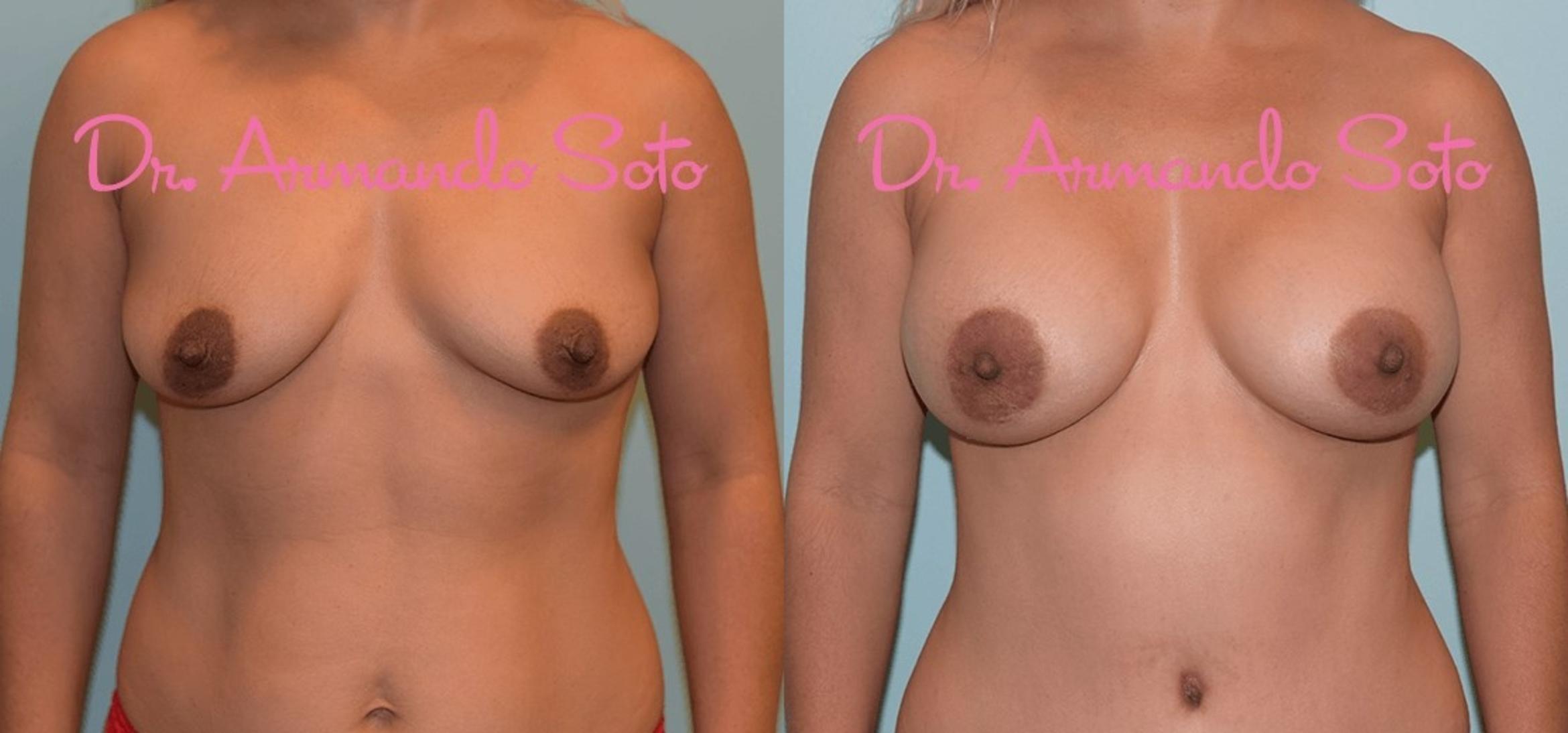 Before & After Breast Augmentation Case 29351 View #1 View in Orlando, FL