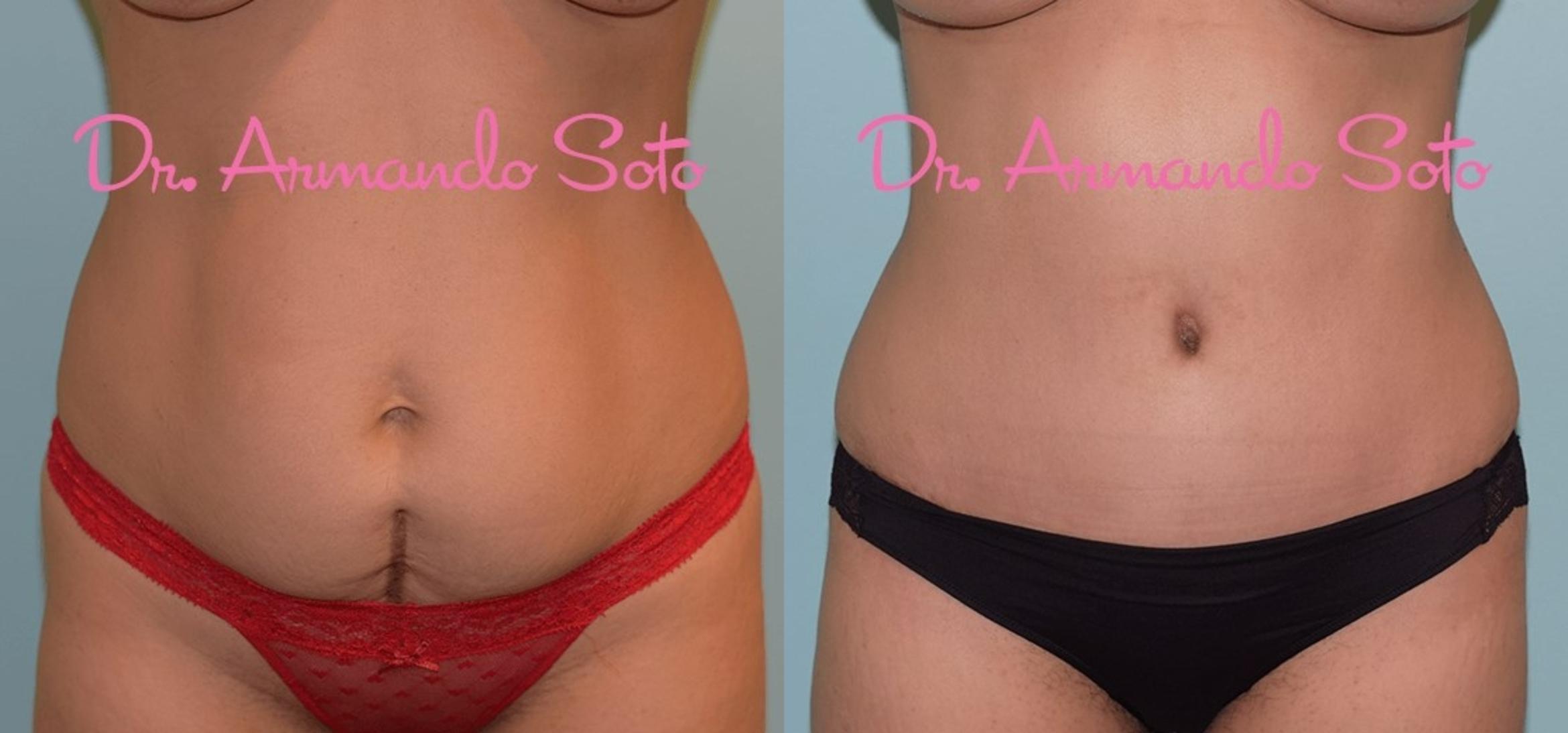 Before & After Breast Augmentation Case 29351 View #2 View in Orlando, FL