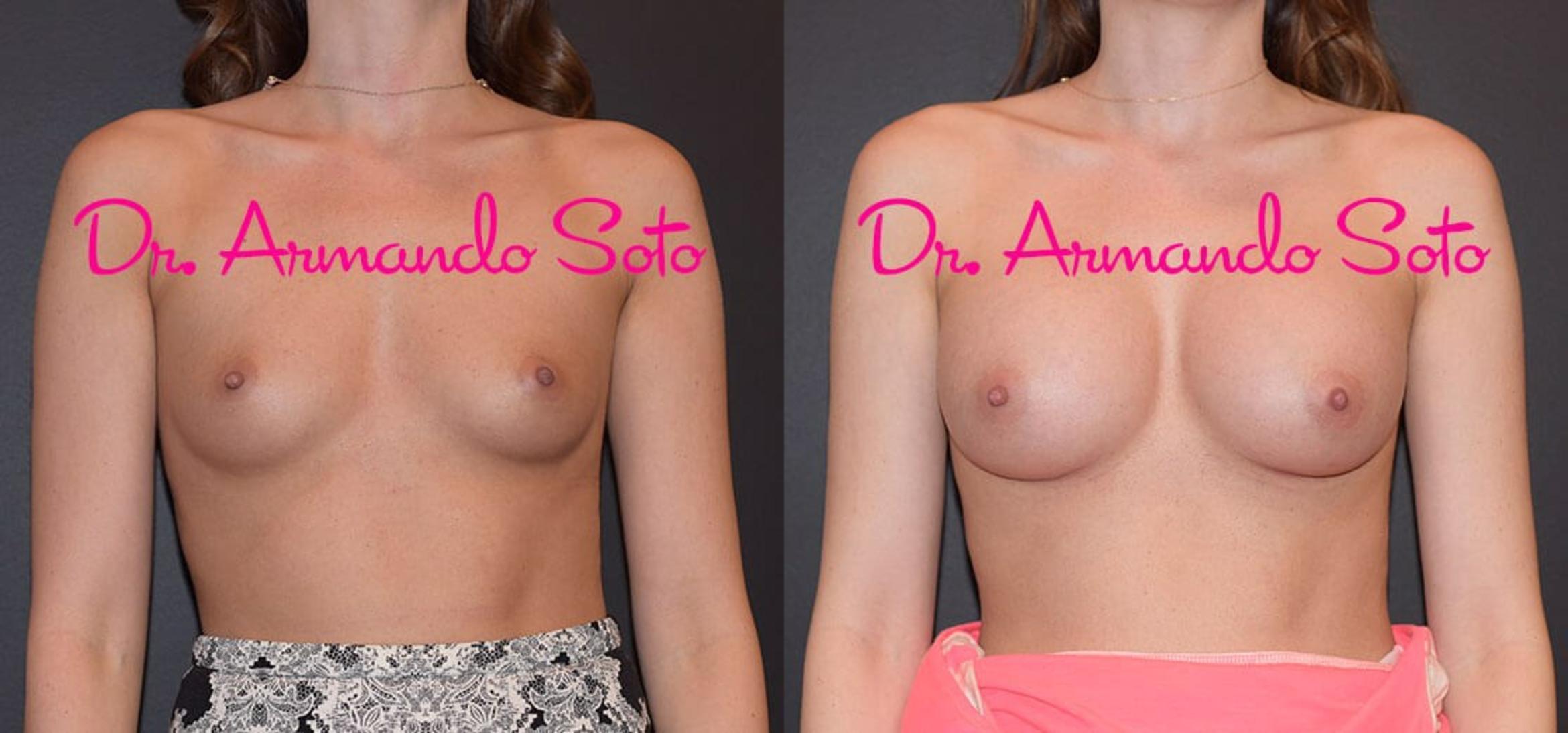 Before & After Breast Augmentation Case 31897 View #1 View in Orlando, FL