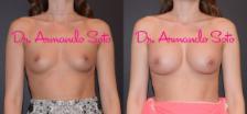 Before & After Breast Augmentation Case 31897 View #1 View in Orlando, FL