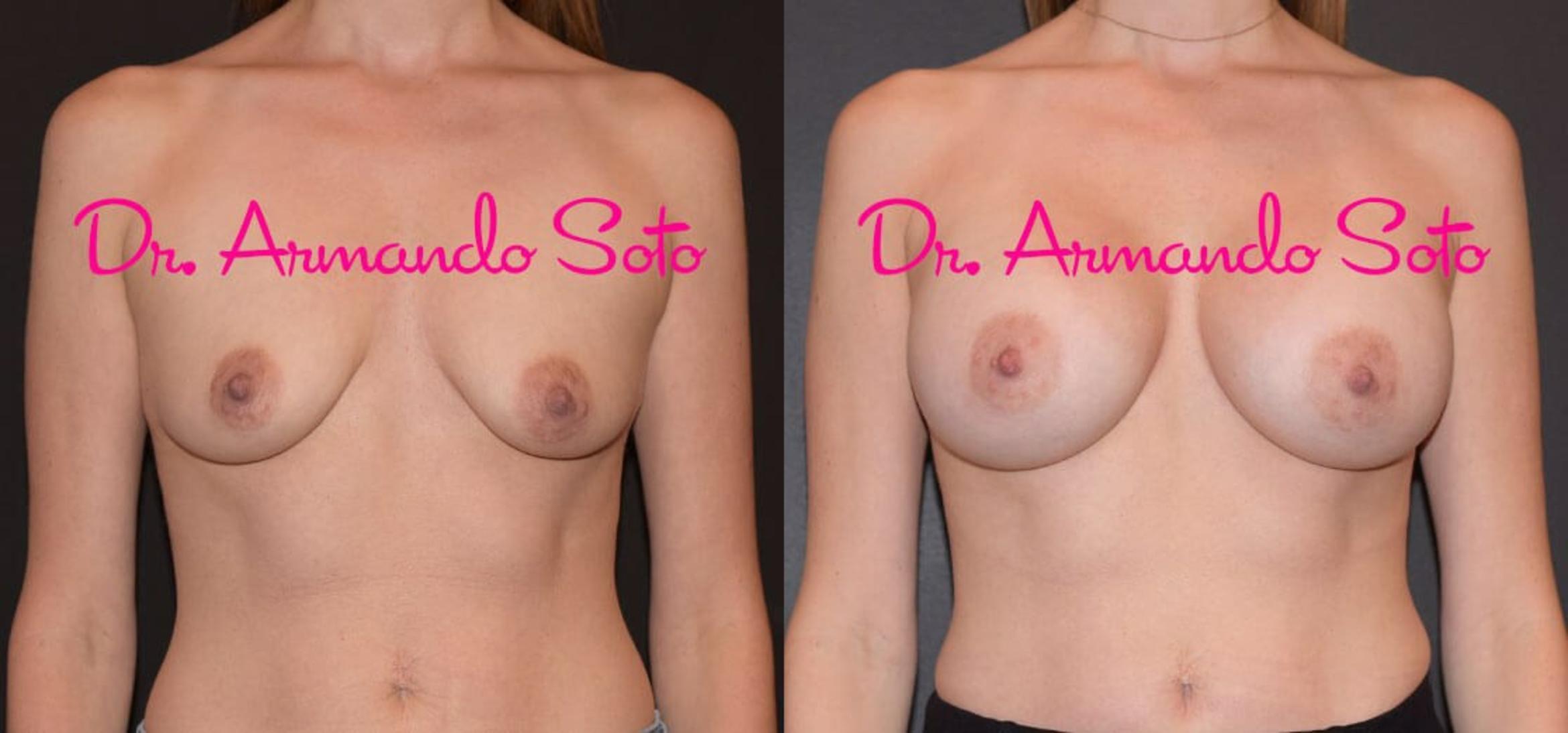 Before & After Breast Augmentation Case 31898 View #1 View in Orlando, FL
