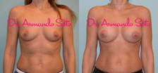 Before & After Breast Augmentation Case 31900 View #1 View in Orlando, FL