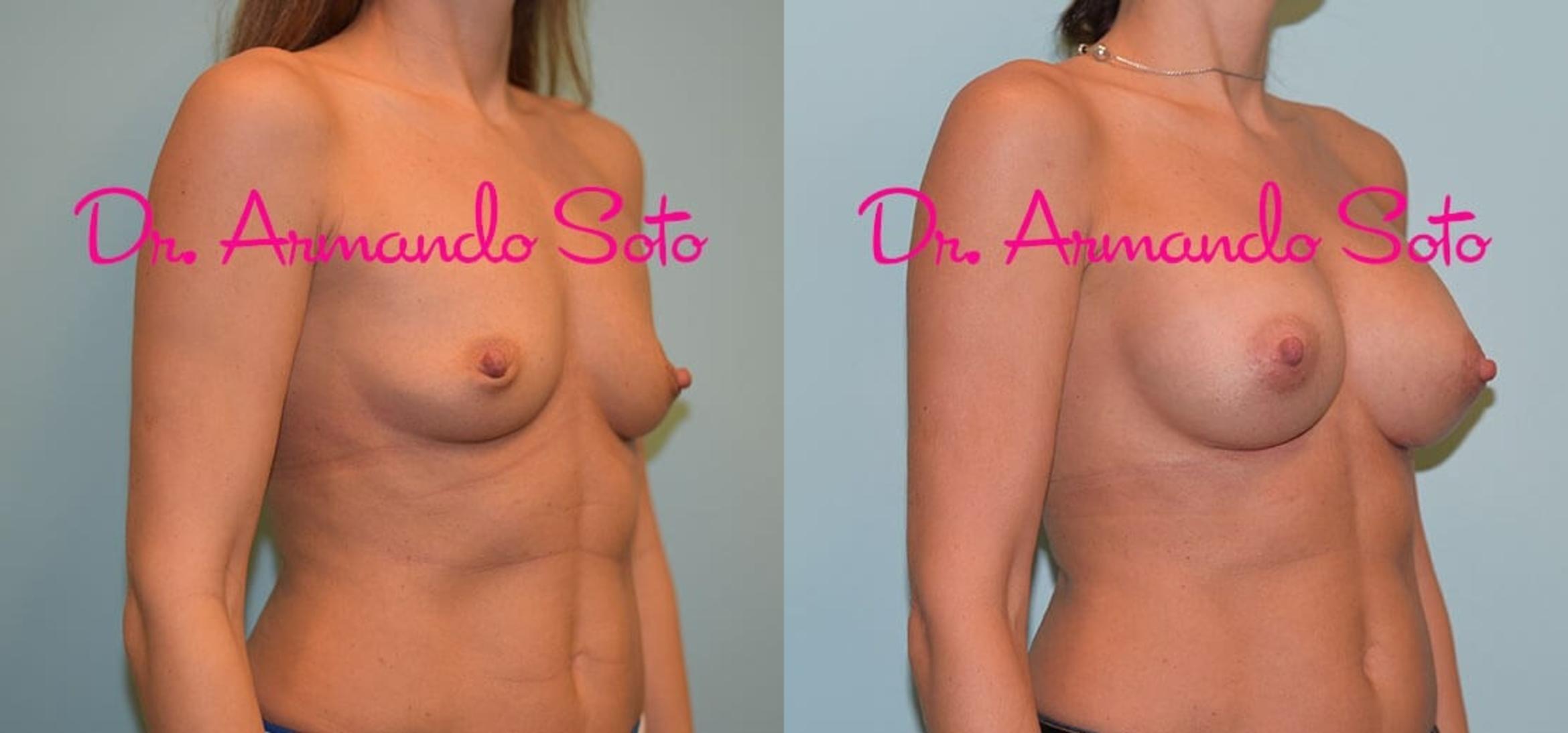 Before & After Breast Augmentation Case 31900 View #2 View in Orlando, FL