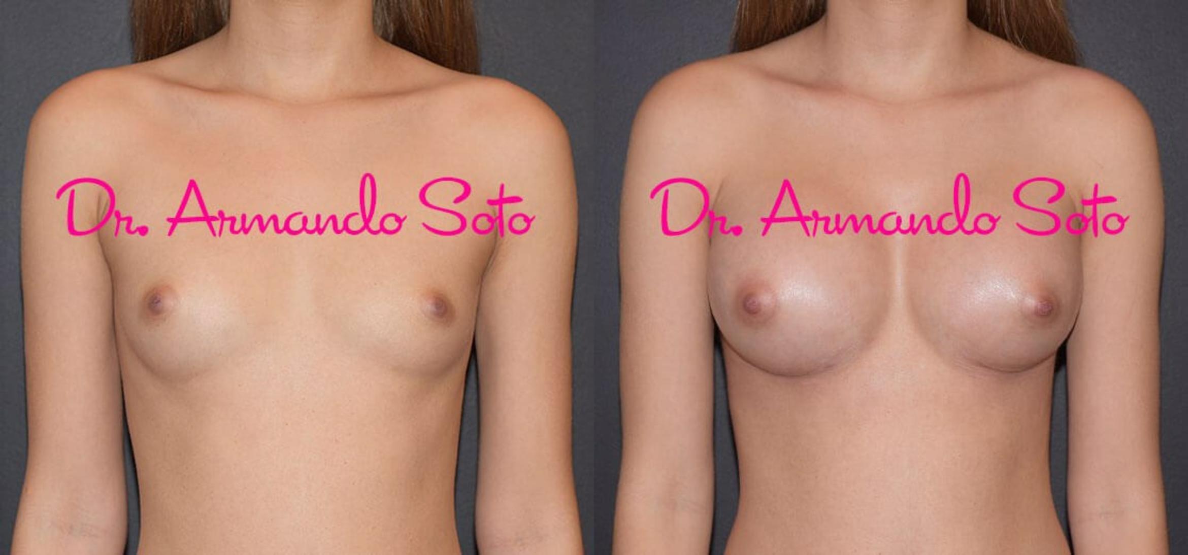 Before & After Breast Augmentation Case 34936 View #1 View in Orlando, FL