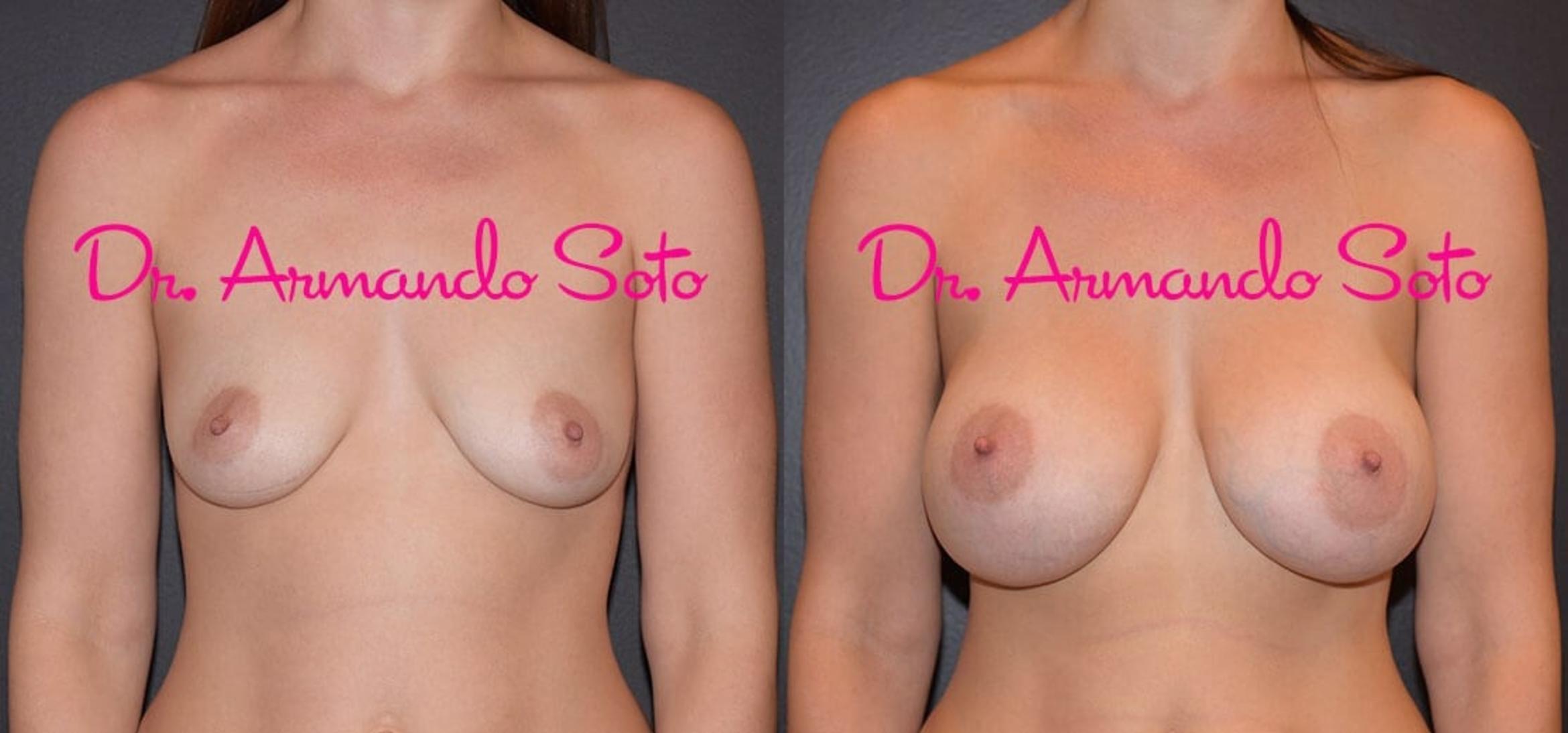 Before & After Breast Augmentation Case 38465 View #1 View in Orlando, FL