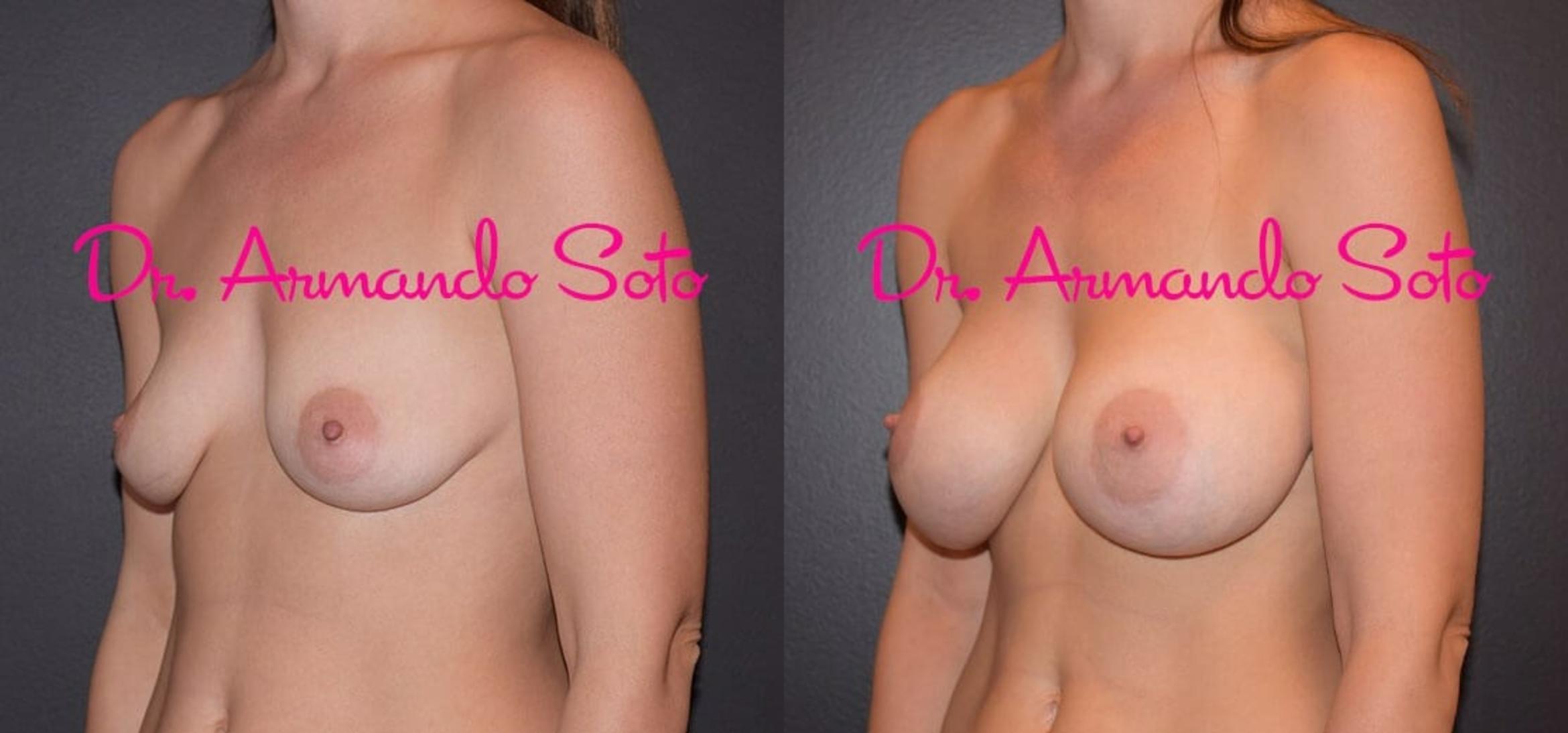 Before & After Breast Augmentation Case 38465 View #2 View in Orlando, FL