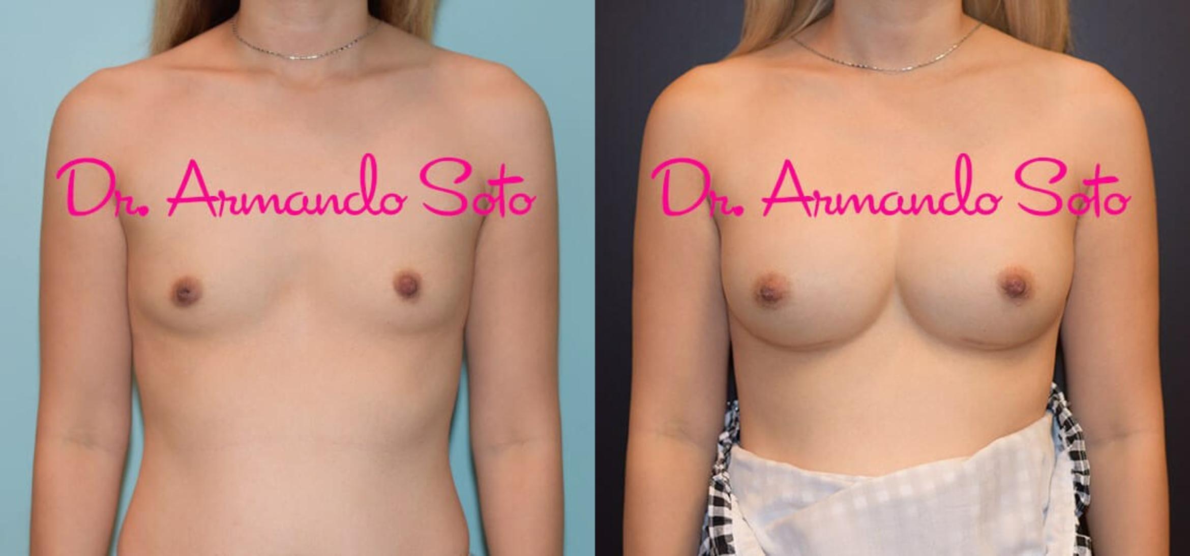 Before & After Breast Augmentation Case 39538 View #1 View in Orlando, FL