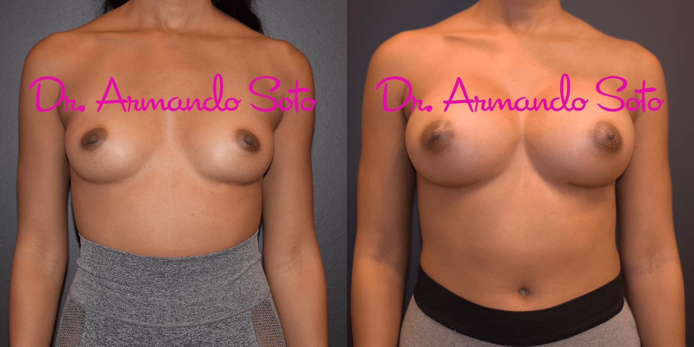 Before & After Breast Augmentation Case 42114 View #1 View in Orlando, FL