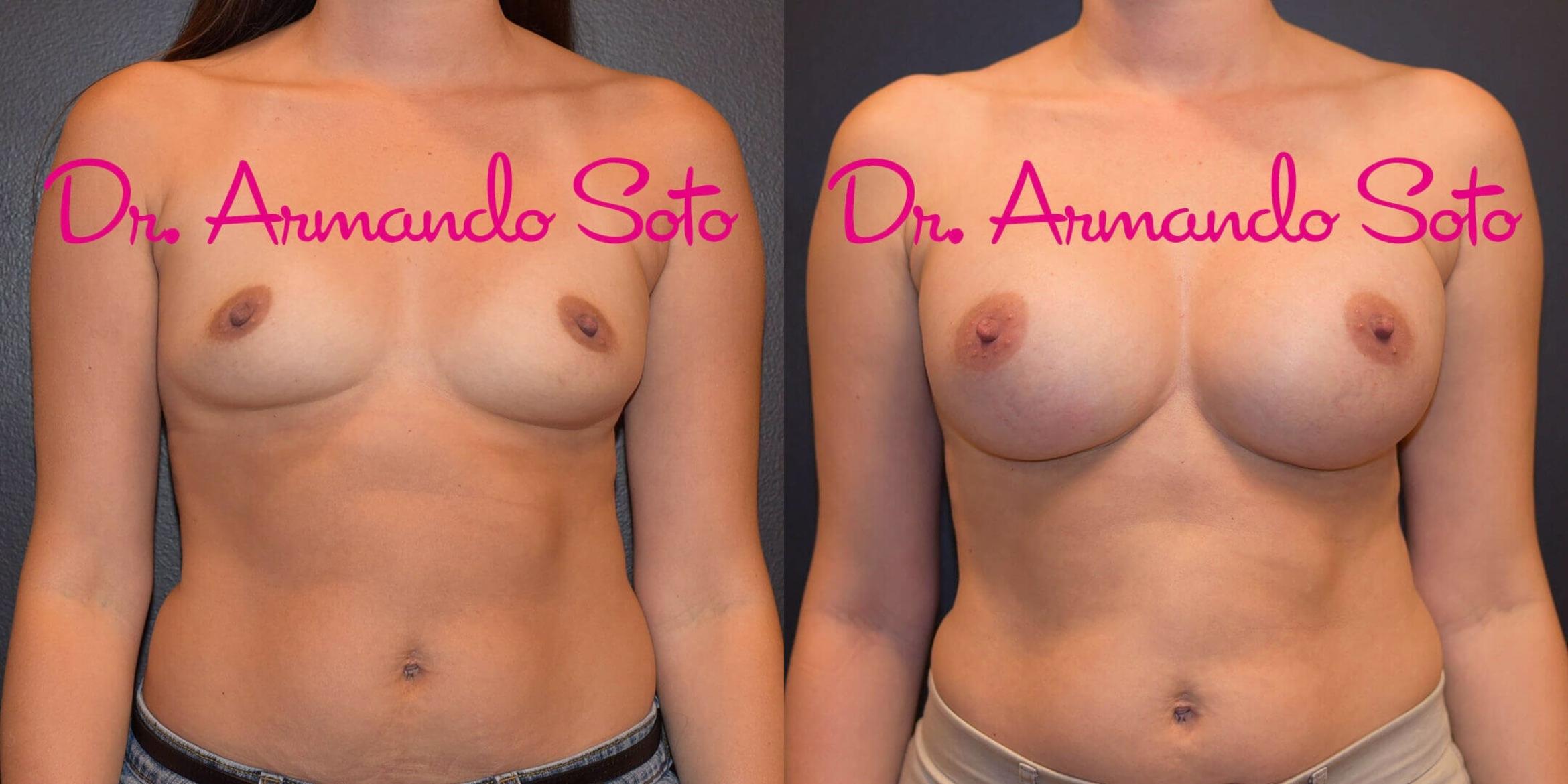 Before & After Breast Augmentation Case 55472 View #1 View in Orlando, FL