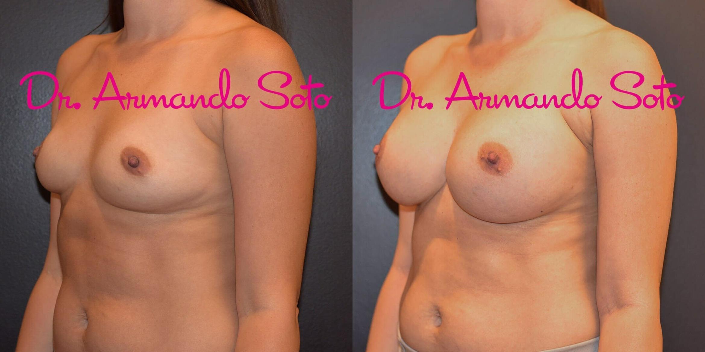 Before & After Breast Augmentation Case 55472 View #2 View in Orlando, FL