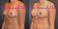 Before & After Breast Augmentation Case 55472 View #2 View in Orlando, FL