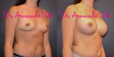 Before & After Breast Augmentation Case 55472 View #3 View in Orlando, FL