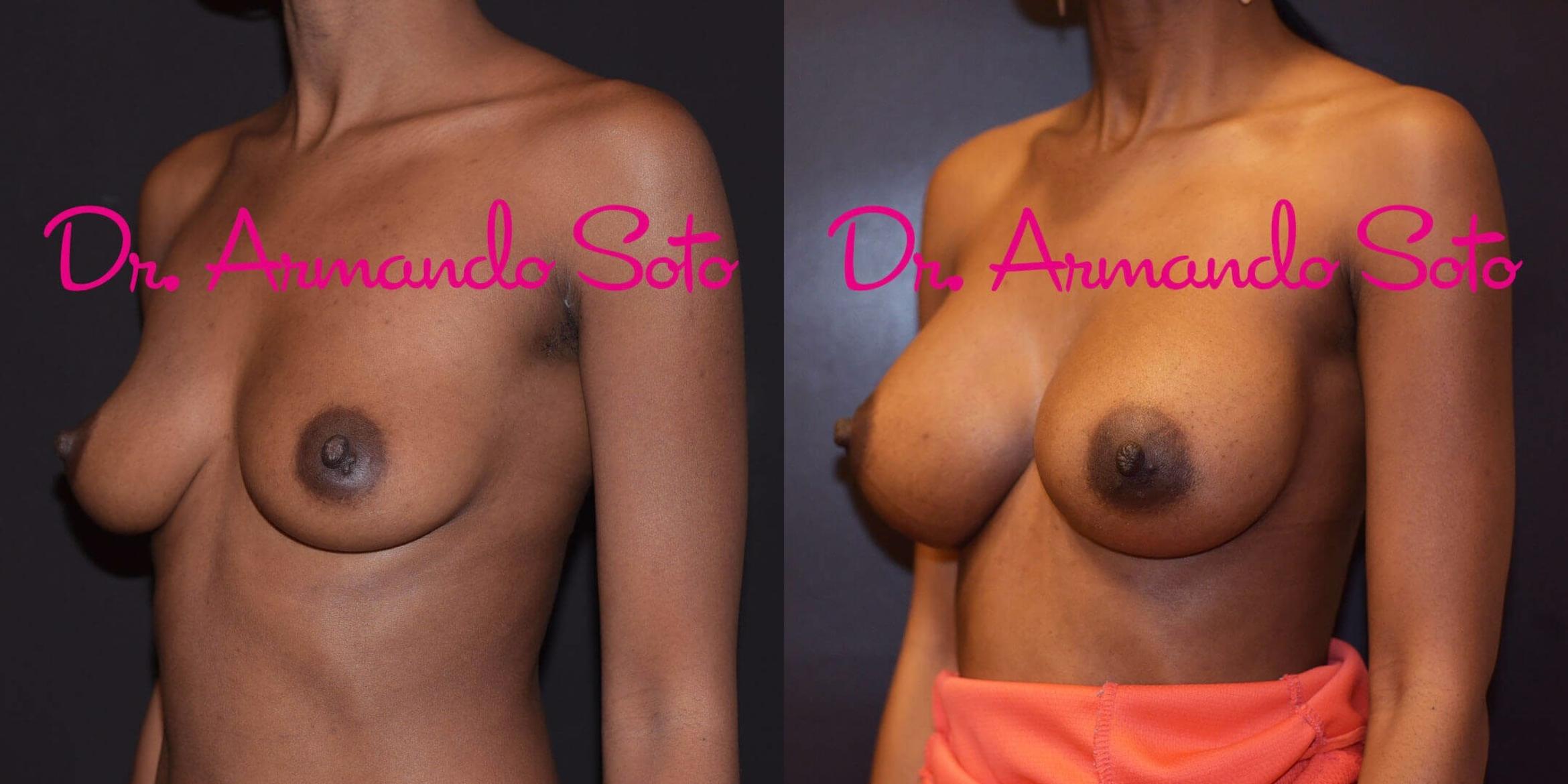 Before & After Breast Augmentation Case 56376 View #2 View in Orlando, FL