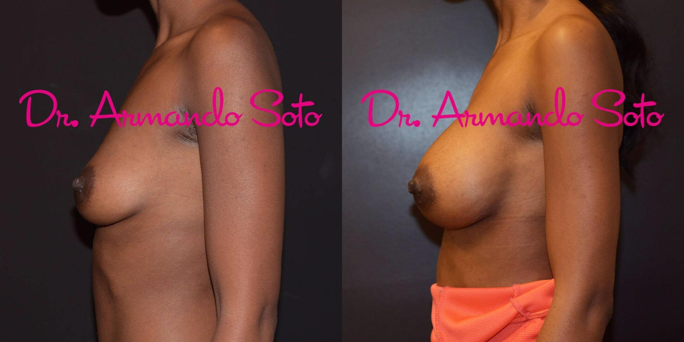 Before & After Breast Augmentation Case 56376 View #3 View in Orlando, FL