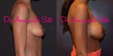 Before & After Breast Augmentation Case 56376 View #4 View in Orlando, FL