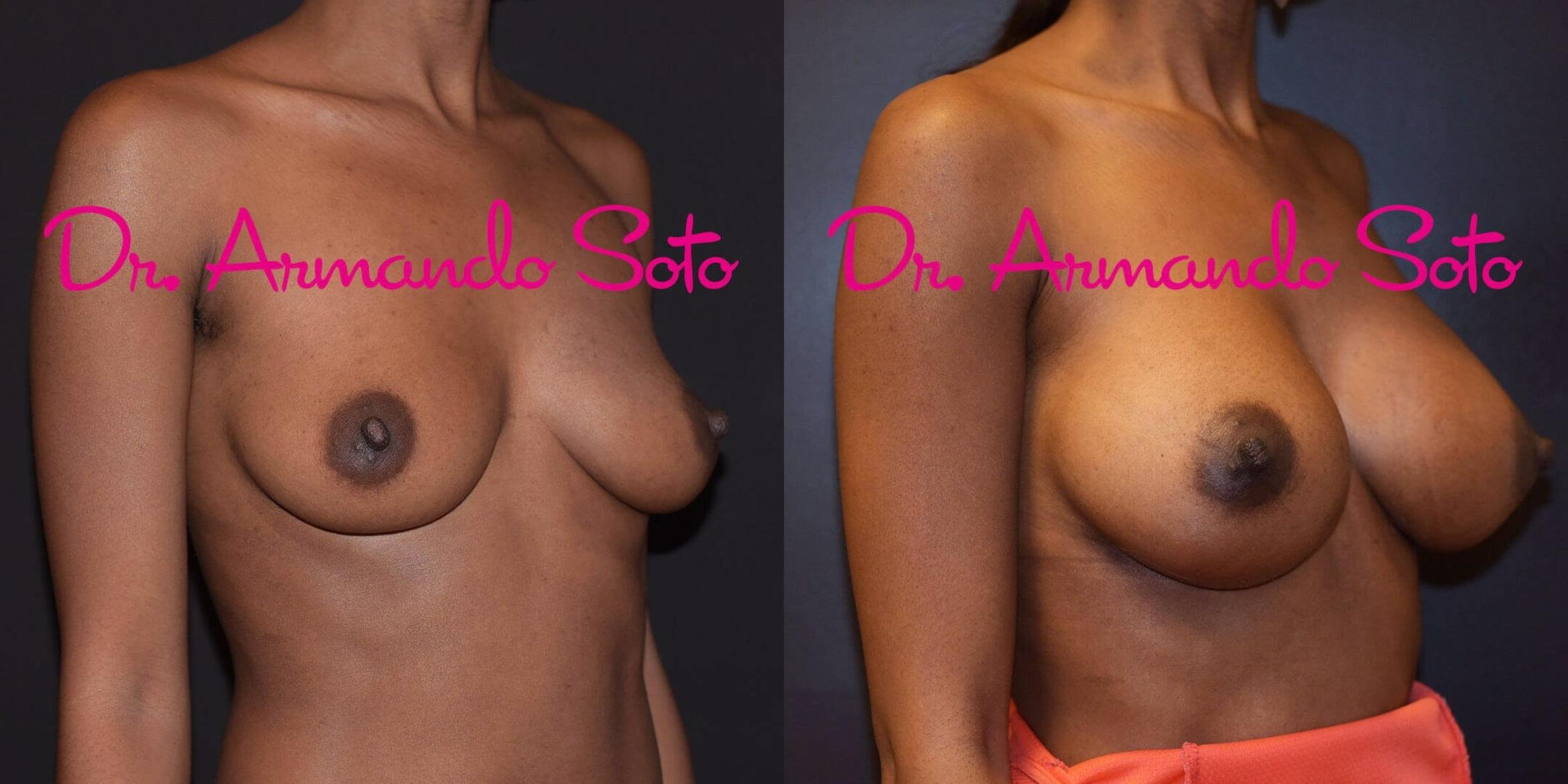 Before & After Breast Augmentation Case 56376 View #5 View in Orlando, FL