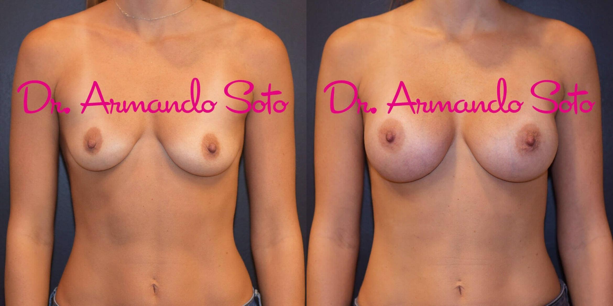 Before & After Breast Augmentation Case 56703 View #1 View in Orlando, FL