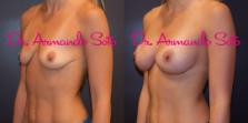 Before & After Breast Augmentation Case 56703 View #2 View in Orlando, FL