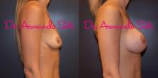 Before & After Breast Augmentation Case 56703 View #4 View in Orlando, FL
