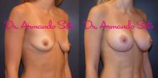 Before & After Breast Augmentation Case 56703 View #5 View in Orlando, FL