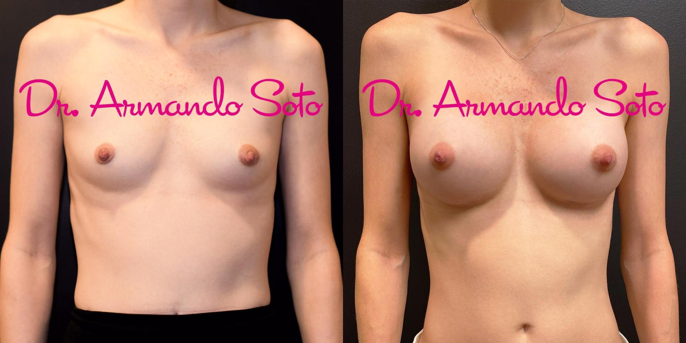 Before & After Breast Augmentation Case 66599 View #1 View in Orlando, FL