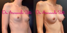Before & After Breast Augmentation Case 66599 View #2 View in Orlando, FL